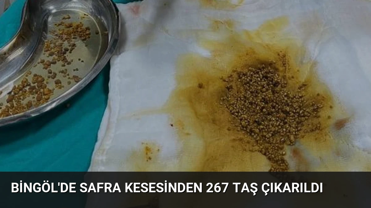 Bingöl’de Safra Kesesinden 267 Taş Çıkarıldı