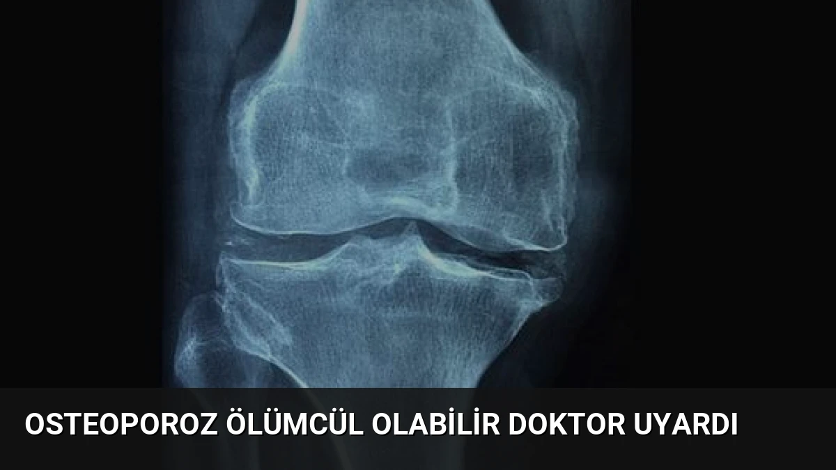 Osteoporoz Ölümcül Olabilir Doktor Uyardı