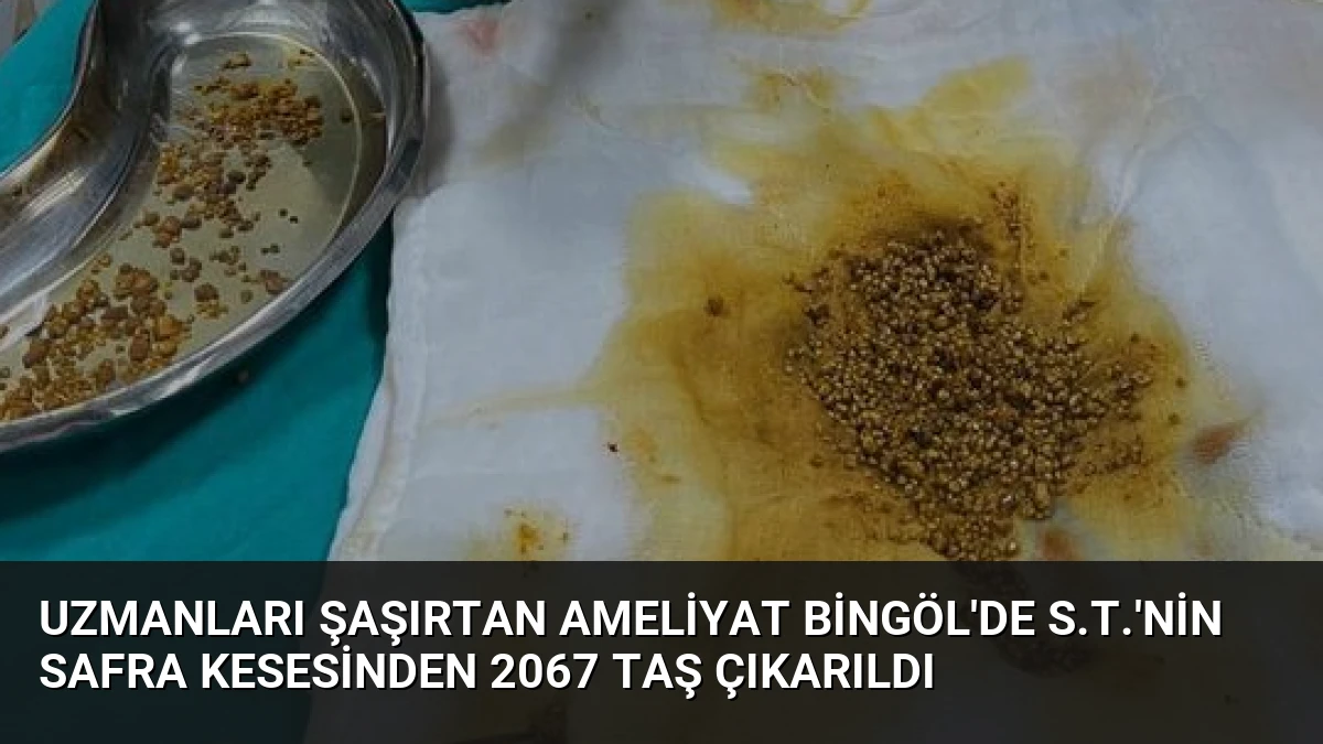 Uzmanları Şaşırtan Ameliyat Bingöl’de S.T.’nin Safra Kesesinden 2067 Taş Çıkarıldı