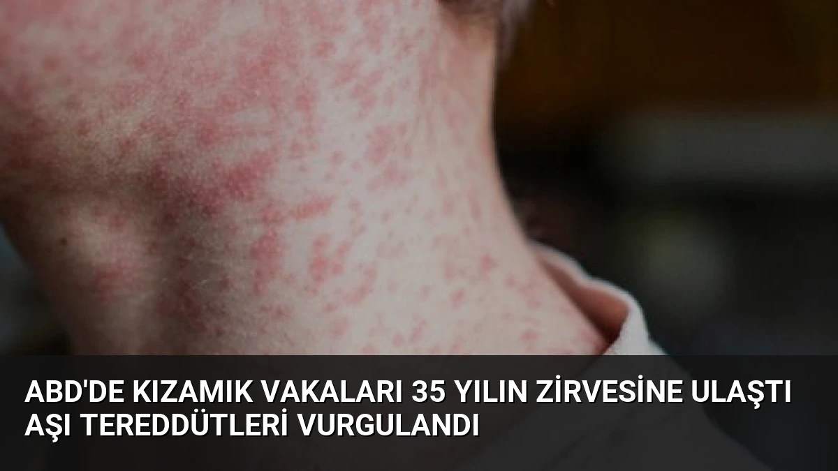 ABD’de Kızamık Vakaları 35 Yılın Zirvesine Ulaştı Aşı Tereddütleri Vurgulandı